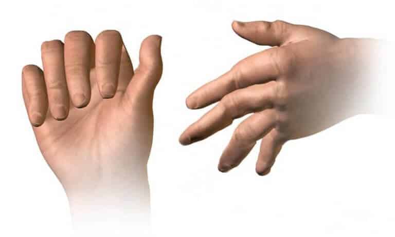 Ketamine Therapy Shows Promise for Treating Rheumatoid Arthritis
