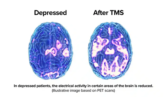 side by side brain scans with dpressed on the left and after TMS treatment on the right. In depressed patients, the electircal activity in  certain areas of the brain is reduced. Images based on PET scans.